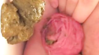 Anal prolapse after pooping