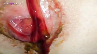 Teen on period shitting