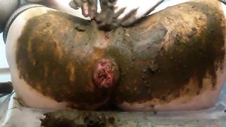 Anal prolapse hard