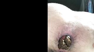 Brunette babe shitting prolapse