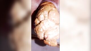 Rectum and hard shit