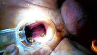 A pair of hands holds on to a clear hose with shit inside