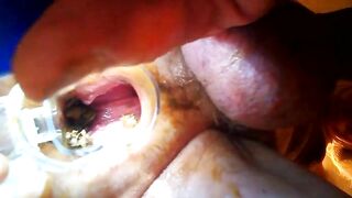 A pair of hands holds on to a clear hose with shit inside