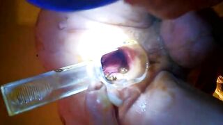 A pair of hands holds on to a clear hose with shit inside