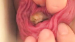 Prolapse after pooping a tiny one